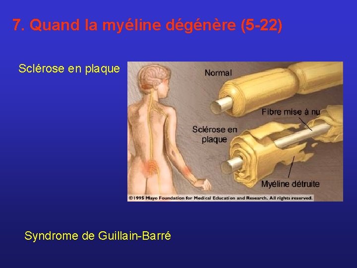 7. Quand la myéline dégénère (5 -22) Sclérose en plaque Syndrome de Guillain-Barré 