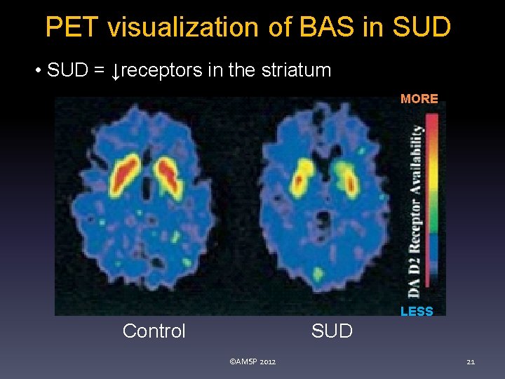 PET visualization of BAS in SUD • SUD = ↓receptors in the striatum MORE