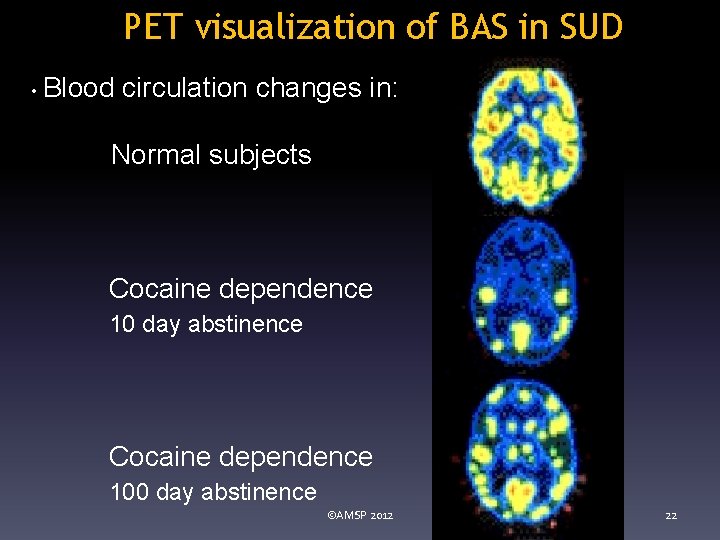 PET visualization of BAS in SUD • Blood circulation changes in: Normal subjects Cocaine