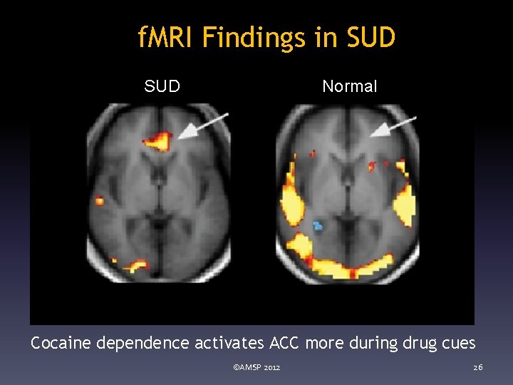 f. MRI Findings in SUD Normal Cocaine dependence activates ACC more during drug cues