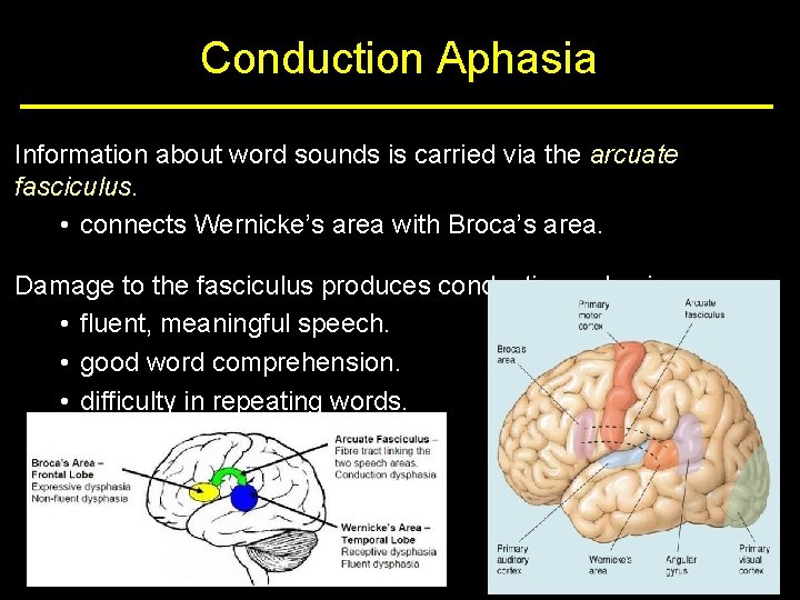 Conduction Aphasia Information about word sounds is carried via the arcuate fasciculus. • connects