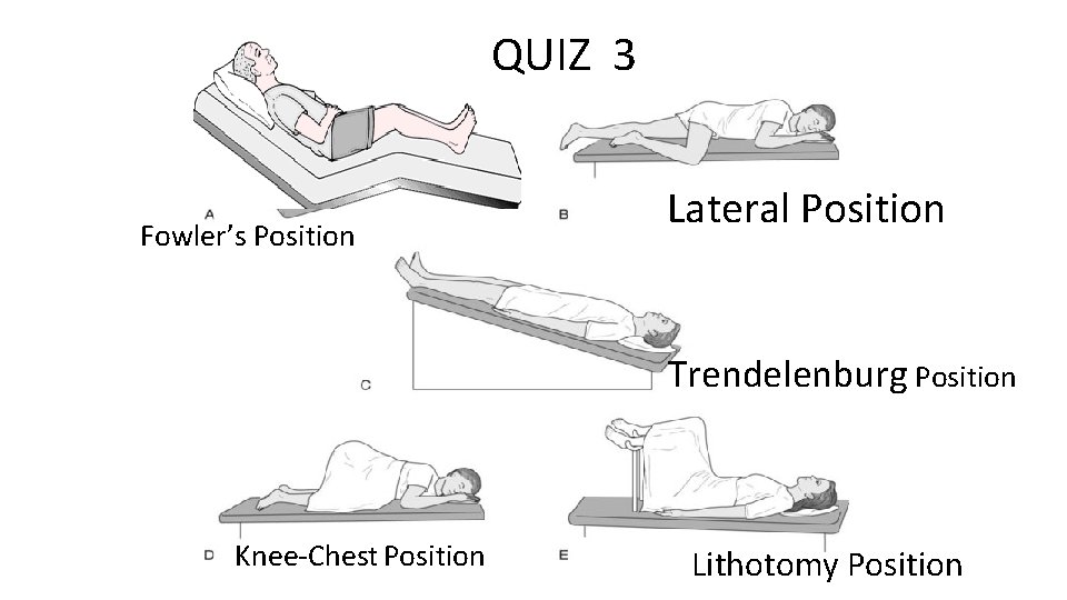 QUIZ 3 Fowler’s Position Lateral Position Trendelenburg Position Knee-Chest Position Lithotomy Position 