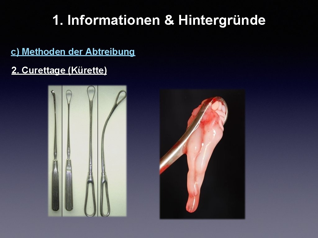 1. Informationen & Hintergründe c) Methoden der Abtreibung 2. Curettage (Kürette) 