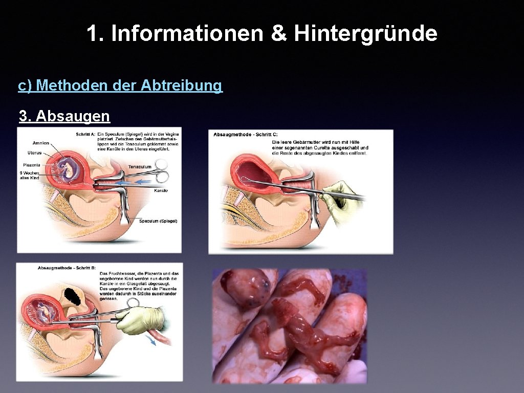 1. Informationen & Hintergründe c) Methoden der Abtreibung 3. Absaugen 