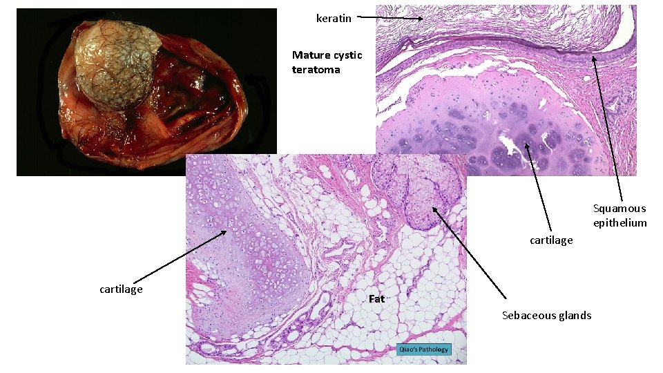 keratin Mature cystic teratoma Squamous epithelium cartilage Fat Sebaceous glands 