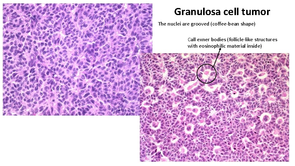 Granulosa cell tumor The nuclei are grooved (coffee-bean shape) Call exner bodies (follicle-like structures