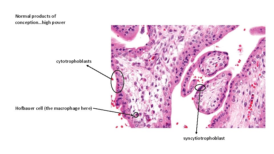 Normal products of conception…high power cytotrophoblasts Hofbauer cell (the macrophage here) syncytiotrophoblast 