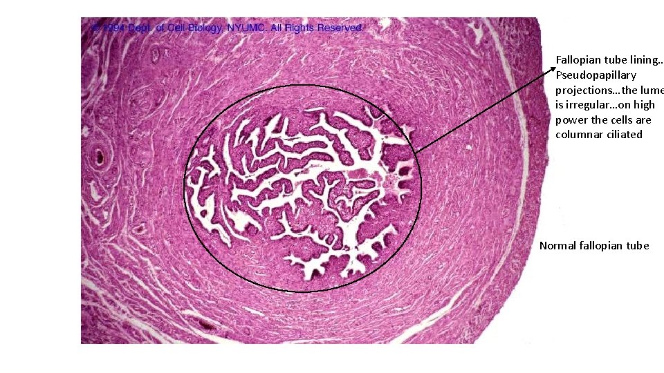 Fallopian tube lining… Pseudopapillary projections…the lume is irregular…on high power the cells are columnar