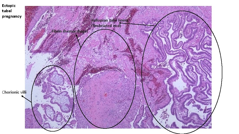 Ectopic tubal pregnancy Fallopian tube lining (fimbriated end) Fibrin (hemorrhage) Chorionic villi 