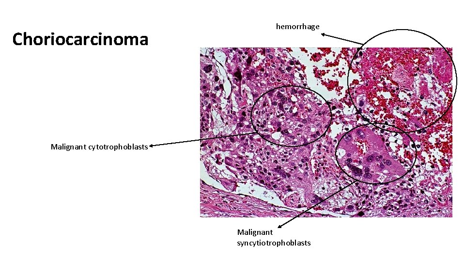 Choriocarcinoma hemorrhage Malignant cytotrophoblasts Malignant syncytiotrophoblasts 