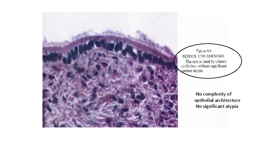 -No complexity of epithelial architecture -No significant atypia 