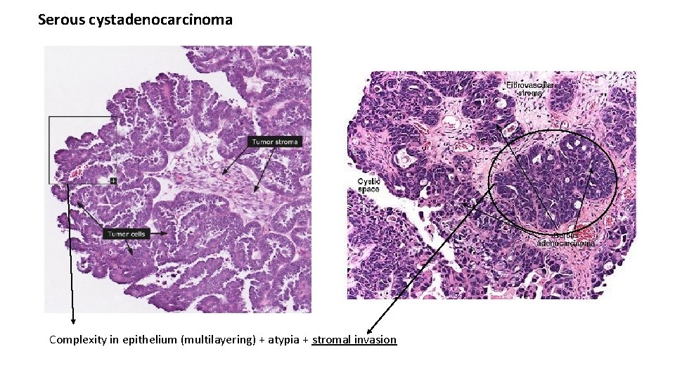 Serous cystadenocarcinoma Complexity in epithelium (multilayering) + atypia + stromal invasion 