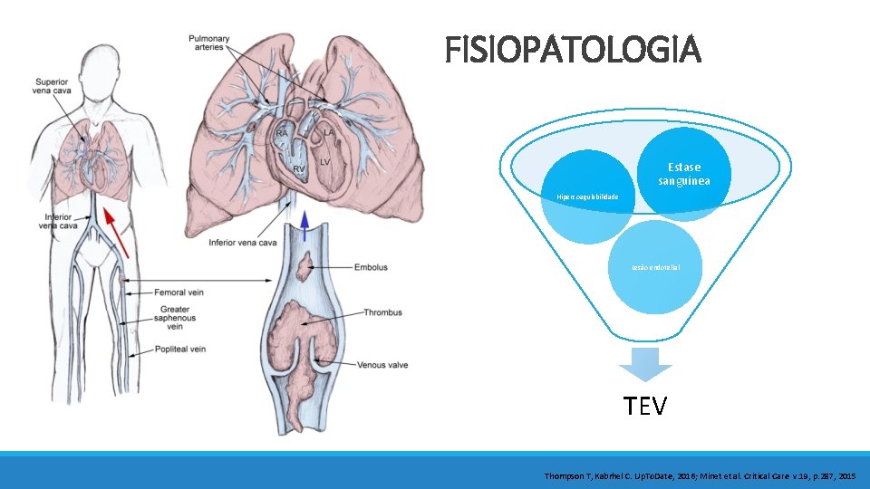 FISIOPATOLOGIA Estase sanguínea Hipercoagulabilidade Lesão endotelial TEV Thompson T, Kabrhel C. Up. To. Date,