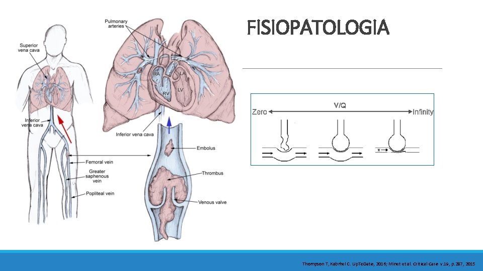 FISIOPATOLOGIA Thompson T, Kabrhel C. Up. To. Date, 2016; Minet et al. Critical Care