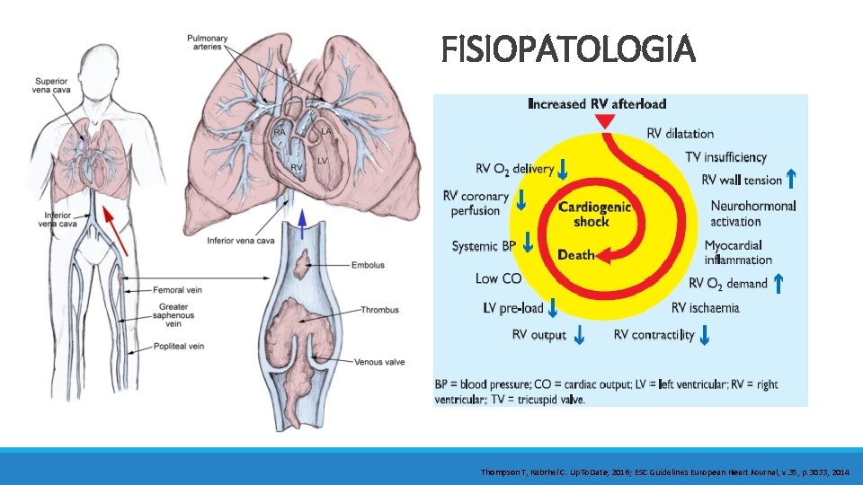 FISIOPATOLOGIA Thompson T, Kabrhel C. Up. To. Date, 2016; ESC Guidelines European Heart Journal,