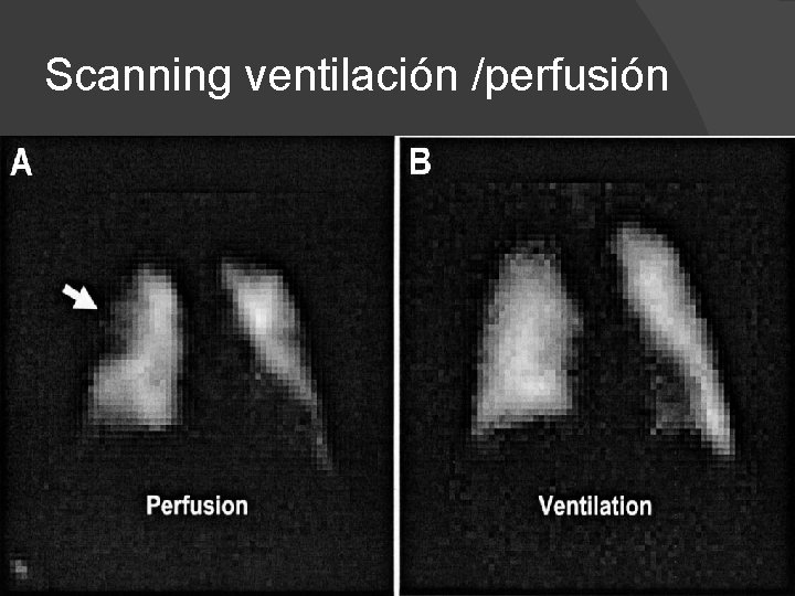 Scanning ventilación /perfusión 