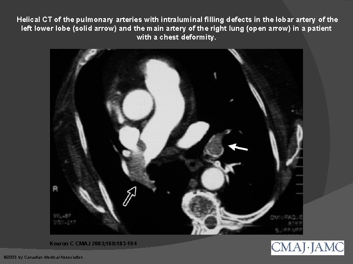 Helical CT of the pulmonary arteries with intraluminal filling defects in the lobar artery
