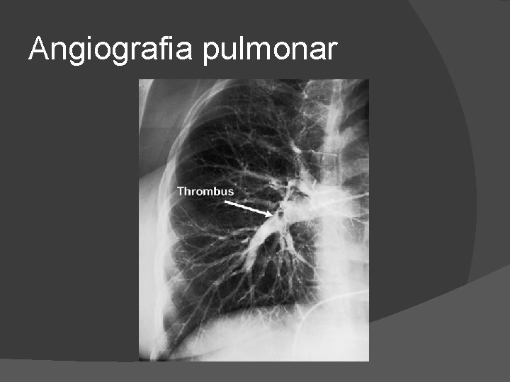 Angiografia pulmonar 