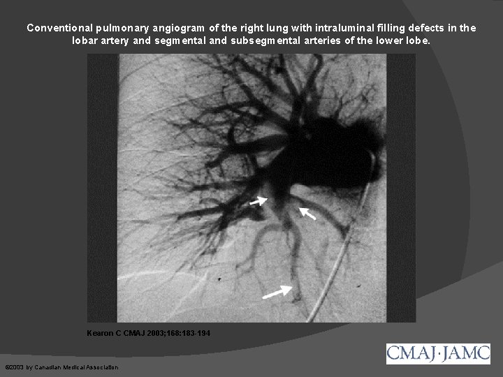 Conventional pulmonary angiogram of the right lung with intraluminal filling defects in the lobar