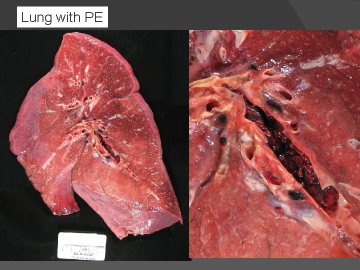 Lung with PE 