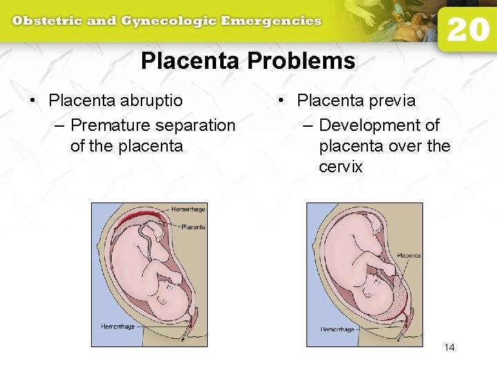 Placenta Problems • Placenta abruptio – Premature separation of the placenta • Placenta previa