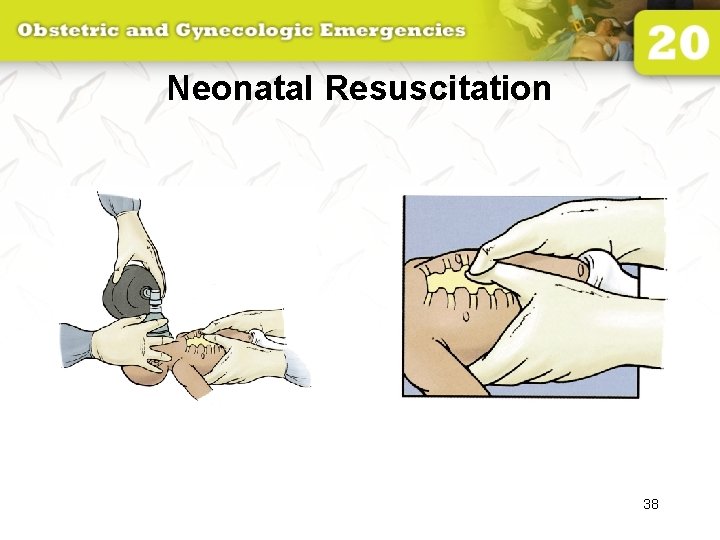 Neonatal Resuscitation 38 