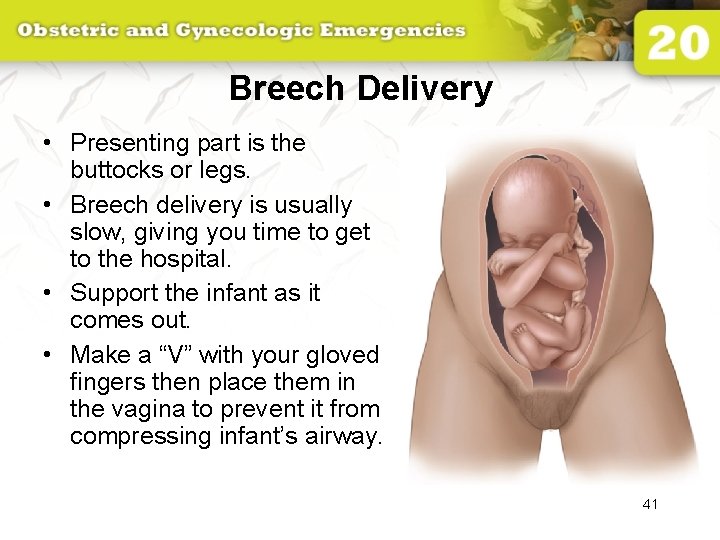 Breech Delivery • Presenting part is the buttocks or legs. • Breech delivery is