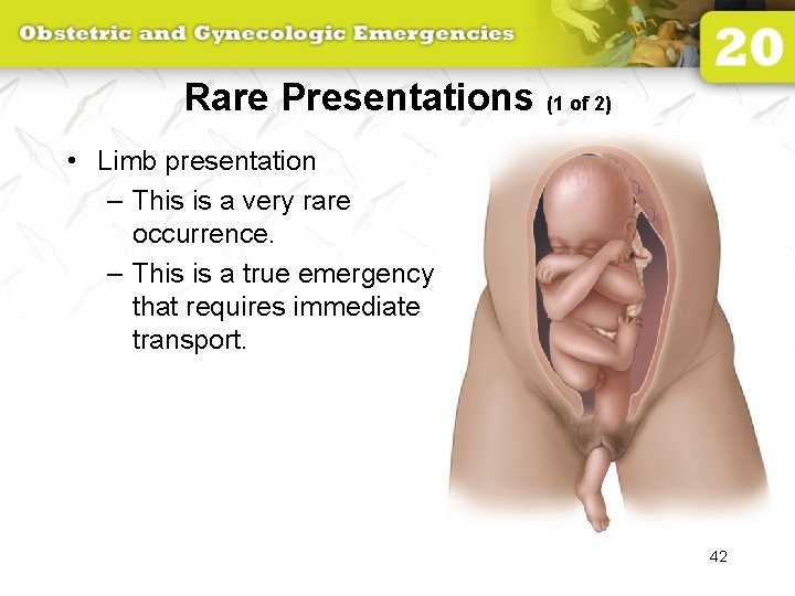 Rare Presentations (1 of 2) • Limb presentation – This is a very rare