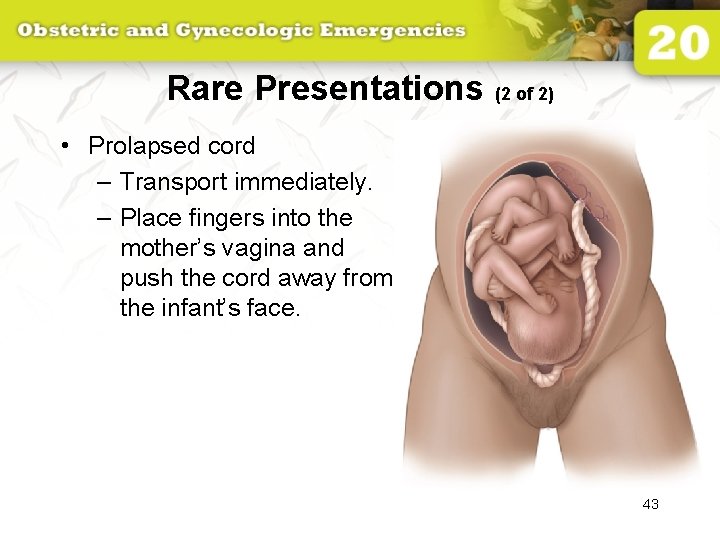 Rare Presentations (2 of 2) • Prolapsed cord – Transport immediately. – Place fingers
