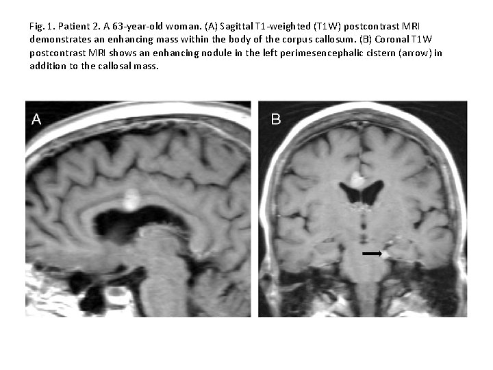 Fig. 1. Patient 2. A 63 -year-old woman. (A) Sagittal T 1 -weighted (T