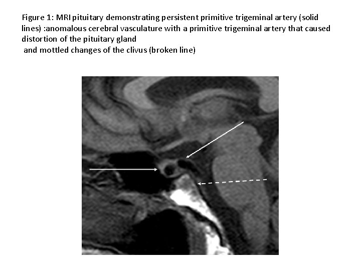 Figure 1: MRI pituitary demonstrating persistent primitive trigeminal artery (solid lines) : anomalous cerebral