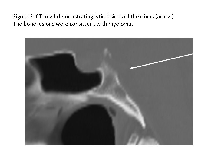 Figure 2: CT head demonstrating lytic lesions of the clivus (arrow) The bone lesions