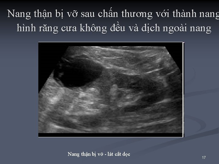 Nang thận bị vỡ sau chấn thương với thành nang hình răng cưa không