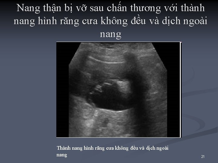 Nang thận bị vỡ sau chấn thương với thành nang hình răng cưa không