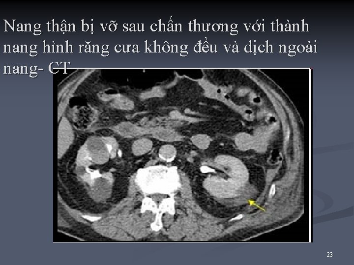 Nang thận bị vỡ sau chấn thương với thành nang hình răng cưa không