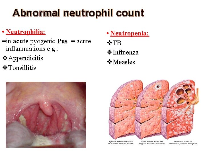 Abnormal neutrophil count • Neutrophilia: =in acute pyogenic Pus = acute inflammations e. g. Abnormal neutrophil count • Neutrophilia: =in acute pyogenic Pus = acute inflammations e. g.