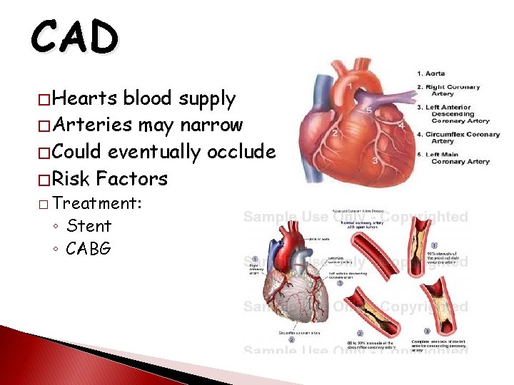 CAD � Hearts blood supply � Arteries may narrow � Could eventually occlude �
