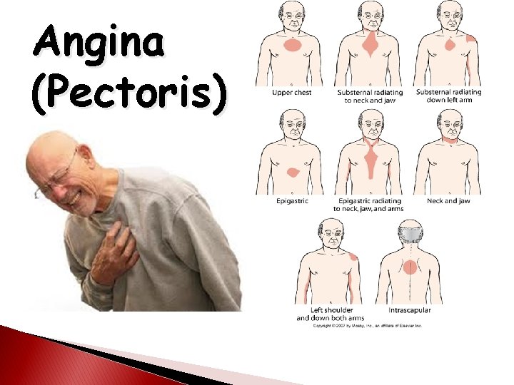 Angina (Pectoris) 
