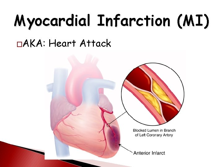 Myocardial Infarction (MI) �AKA: Heart Attack 