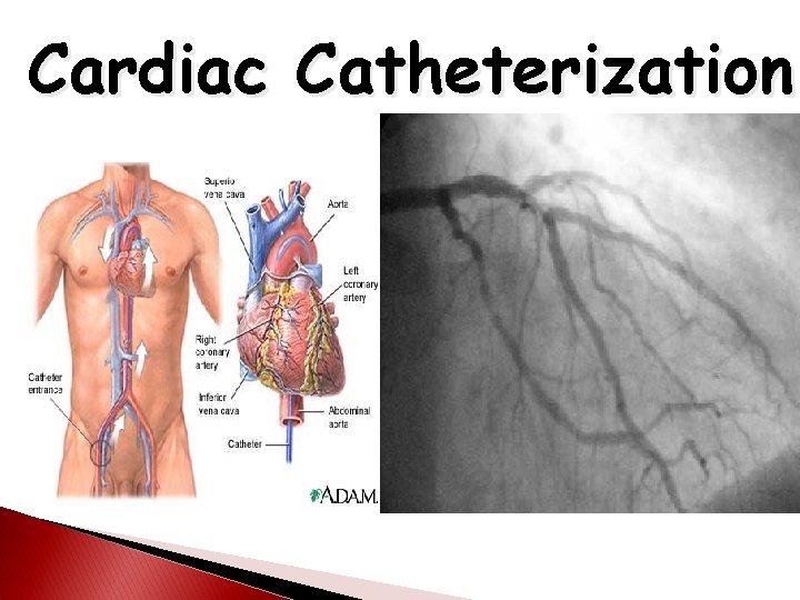 Cardiac Catheterization 