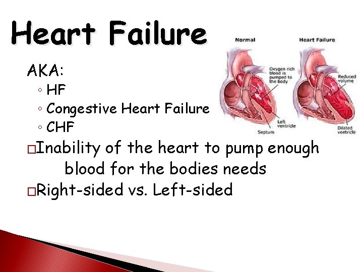 Heart Failure AKA: ◦ HF ◦ Congestive Heart Failure ◦ CHF �Inability of the