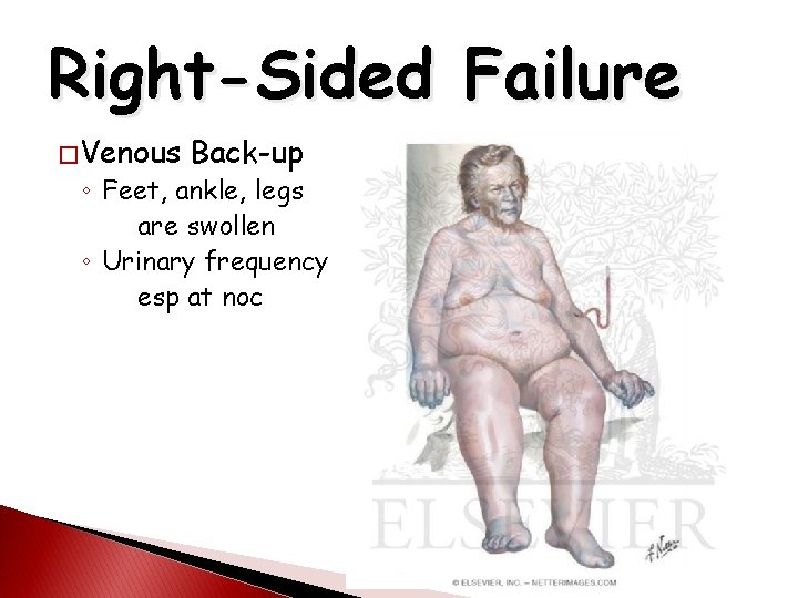Right-Sided Failure � Venous Back-up ◦ Feet, ankle, legs are swollen ◦ Urinary frequency