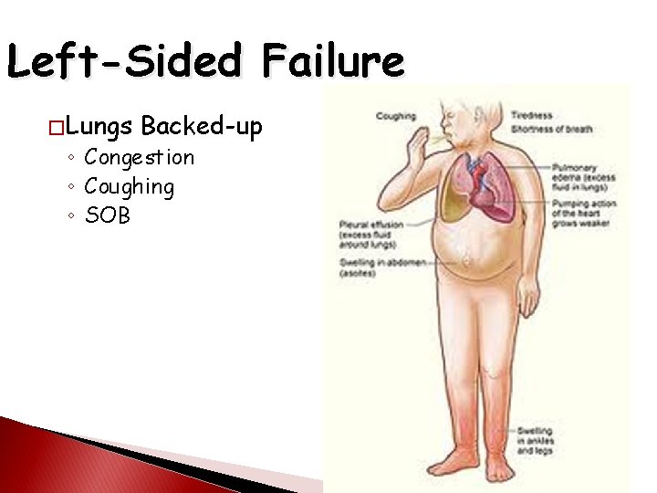 Left-Sided Failure � Lungs Backed-up ◦ Congestion ◦ Coughing ◦ SOB 