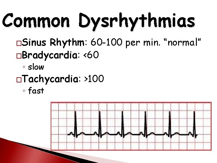 Common Dysrhythmias �Sinus Rhythm: 60 -100 per min. “normal” �Bradycardia: <60 ◦ slow �Tachycardia: