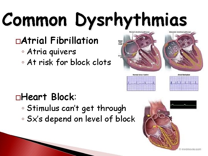 Common Dysrhythmias �Atrial Fibrillation �Heart Block: ◦ Atria quivers ◦ At risk for block