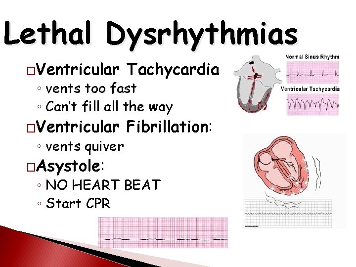 Lethal Dysrhythmias �Ventricular Tachycardia �Ventricular Fibrillation: ◦ vents too fast ◦ Can’t fill all