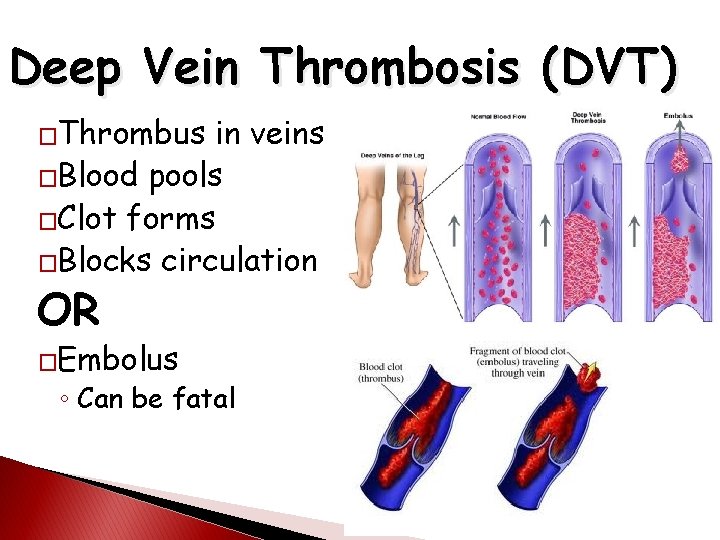 Deep Vein Thrombosis (DVT) �Thrombus in veins �Blood pools �Clot forms �Blocks circulation OR