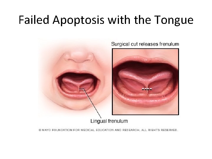Failed Apoptosis with the Tongue 