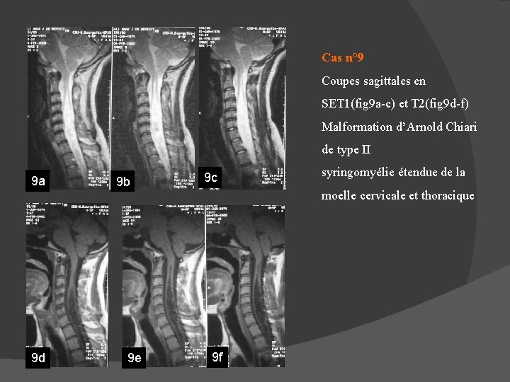 Cas n° 9 Coupes sagittales en SET 1(fig 9 a-c) et T 2(fig 9