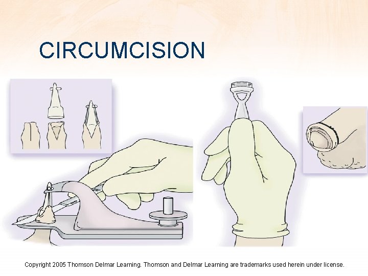 CIRCUMCISION Copyright 2005 Thomson Delmar Learning. Thomson and Delmar Learning are trademarks used herein